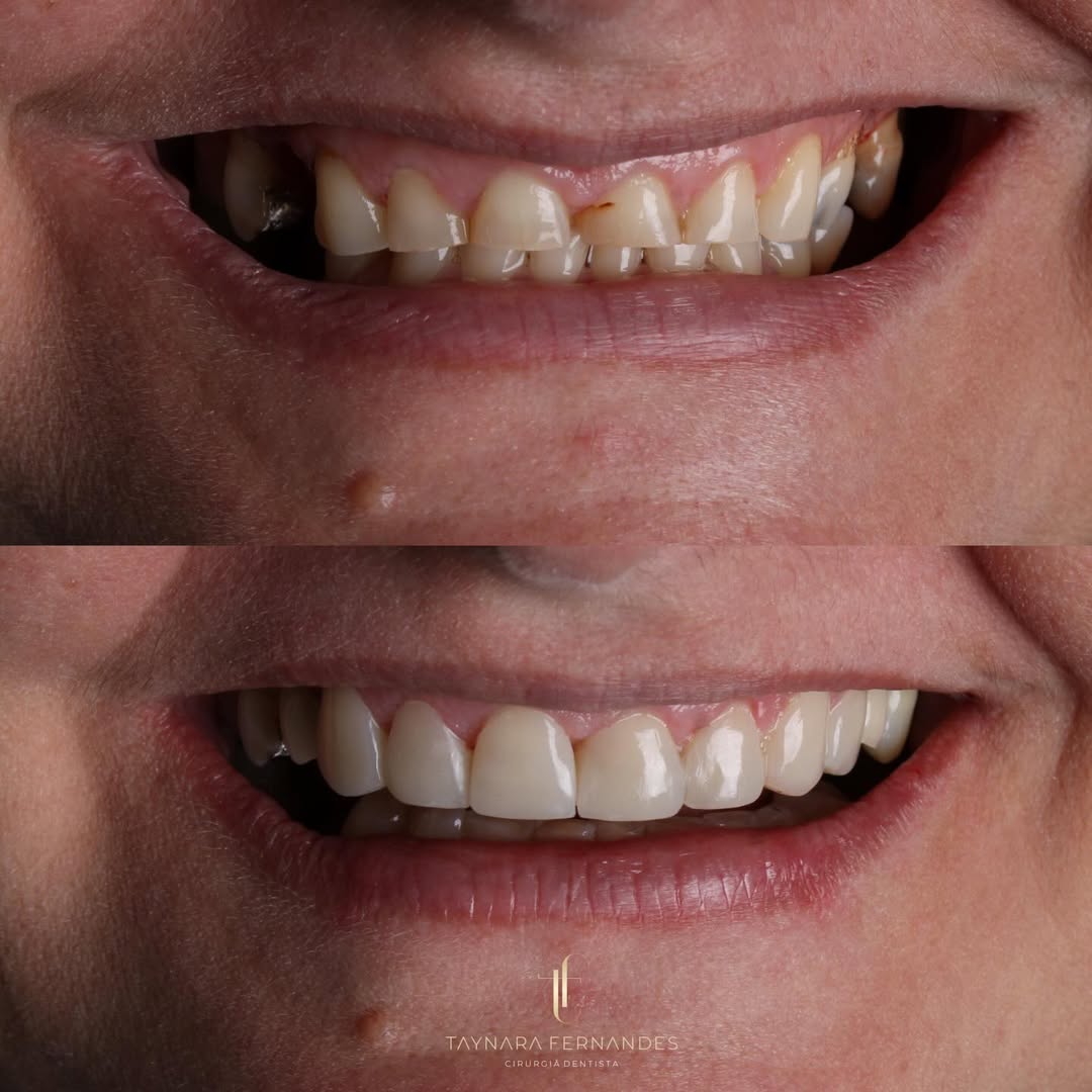 Reabilitação de Sorriso (antes e depois)